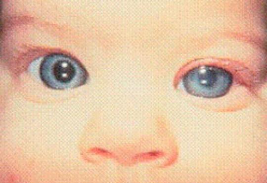 Glaucoma congénito